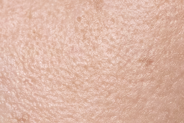皮膚乾燥-皮膚屏障受損-皮膚敏感症狀