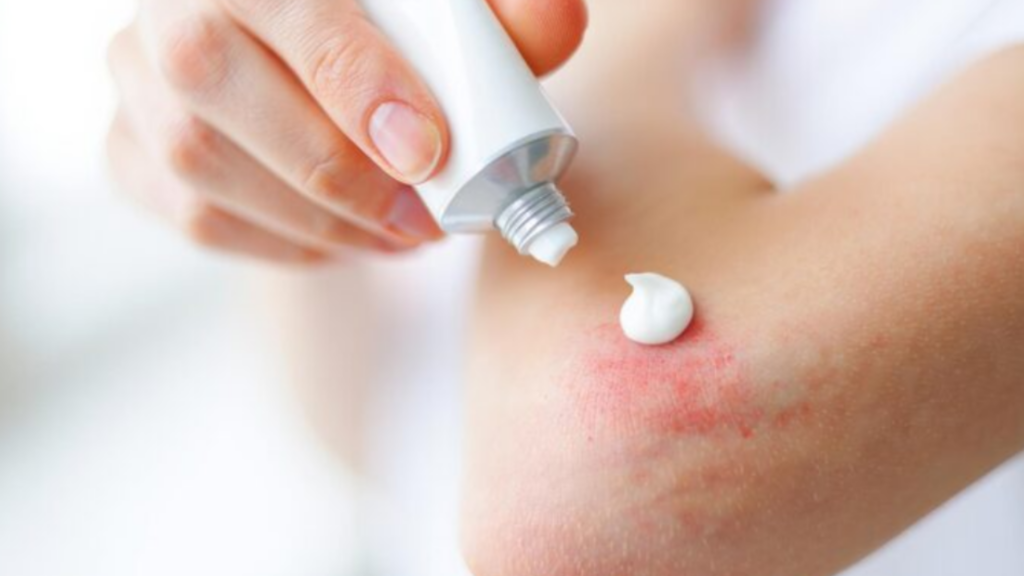 濕疹種類-濕疹成因-濕疹攻略